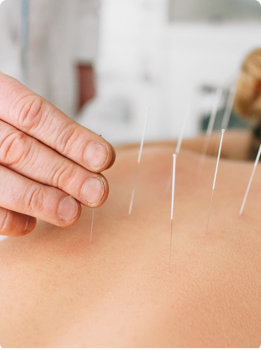 Acupuncture